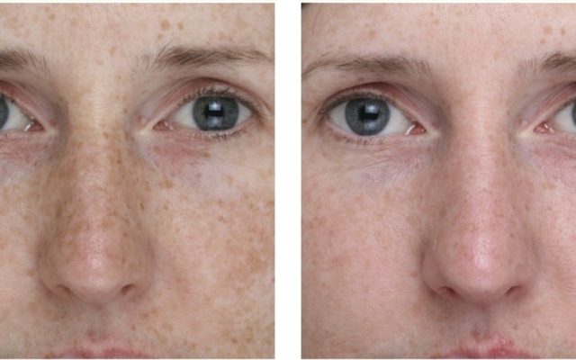 even skin tone treatment